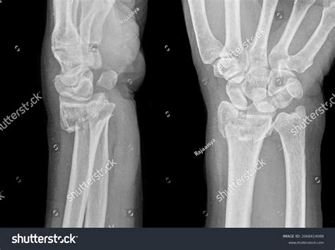 Image result for Fractured Radius