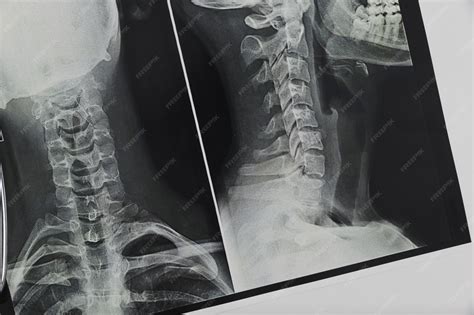 Image result for Neck X-Ray