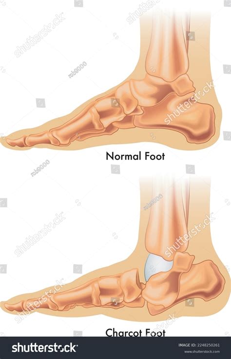 Acute Charcot Foot