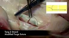 Modification Stitches by Tang 6 Strand Flexor Tendon Repair Modification Stitches