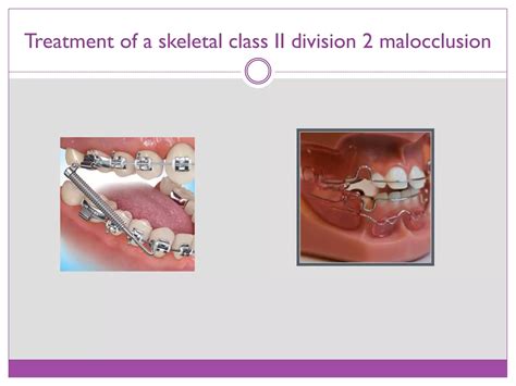 Class II division 2 malocclusion | PPTX