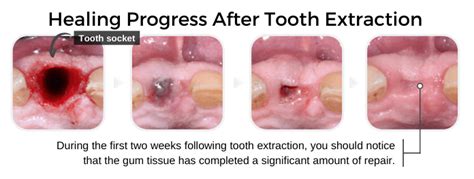 Post Tooth Extraction Healing 的图像结果