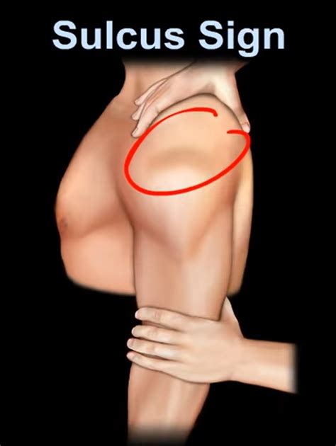 Image result for Sulcus Sign Shoulder