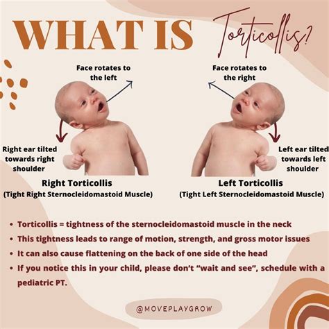 What Is Torticollis