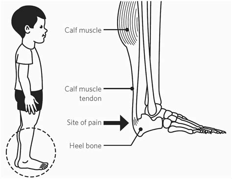 stretches for sever's disease Sever disease treatment exercises ...