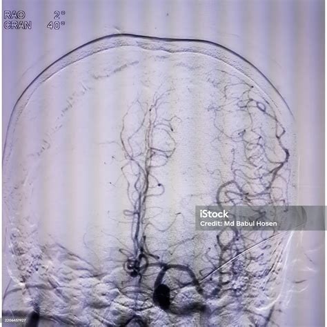 Digital Subtraction Angiography Or Cerebral Angiography Of Brain Digital Arteriogram Stock Photo ...