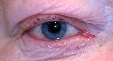 Bildergebnis für blepharitis ansteckend