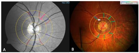 Retinal Vessel Flicker Light Responsiveness and Its Relation to ...