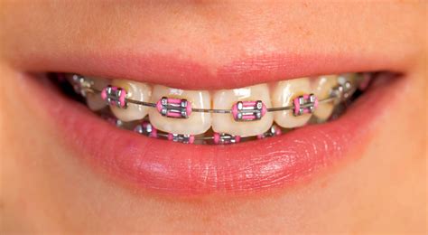 Brackets Dental En Ingles at Salvador Simpson blog