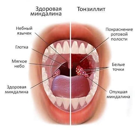 Хронический тонзиллит: симптомы, причины, факторы риска