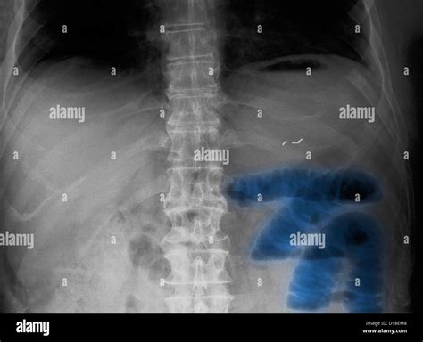 Abdominal X-ray, small bowel obstruction Stock Photo - Alamy