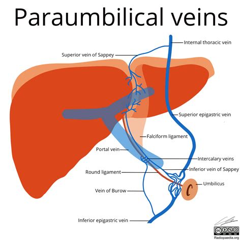 Radiopaedia - Drawing Paraumbilical veins - English labels | AnatomyTOOL