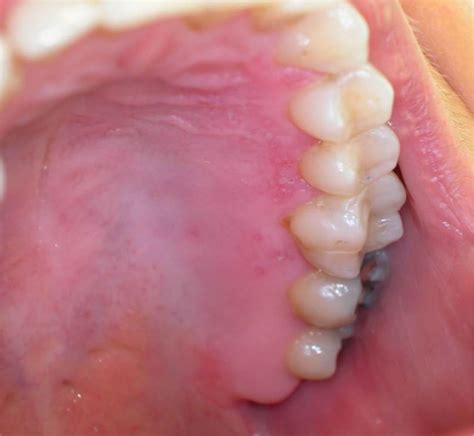 Oral Herpes Gums at Sofia Flick blog