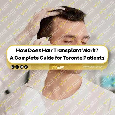 How Does Hair Transplant Work? A Complete Guide for Toronto Patients – Vip Hair Transplant ...