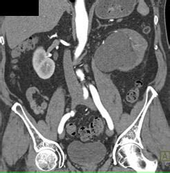 Kuvatulokset haulle parapelvic cyst kidney