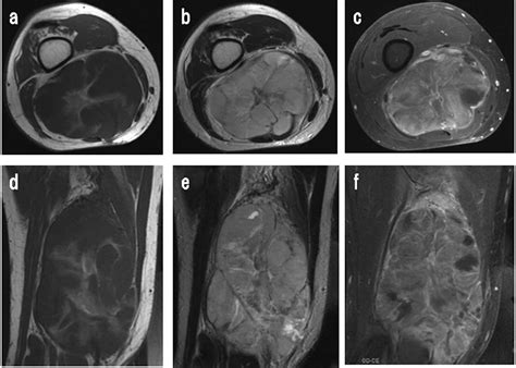 Image result for Soft Tissue Sarcoma Hand