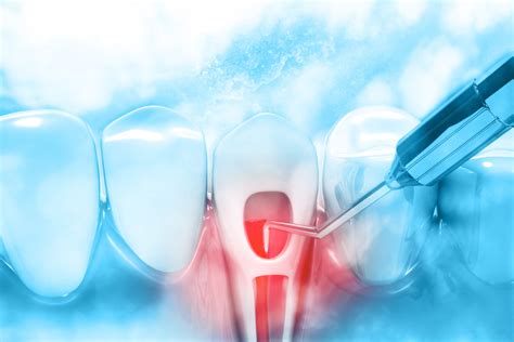 What Is Endodontic Retreatment?