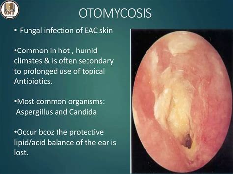 Ear Fungal Infection