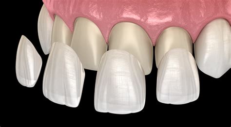 A Complete Guide to the Different Types of Veneers - Newbury Dental Group