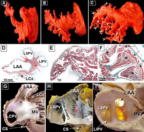 Left atrial appendage: anatomy and imaging landmarks pertinent to percutaneous transcatheter ...