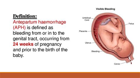 SOLUTION: Antepartum haemorrhage made easy - Studypool