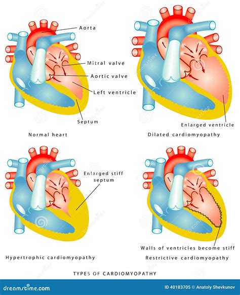 Diseases of the Heart Muscle Stock Vector - Illustration of aorta, medicine: 40183705