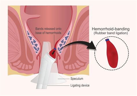 Hemorrhoid Sclerotherapy Before And After