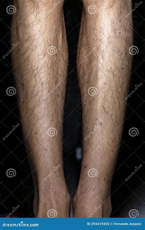 Vasculitis. Vasculitis in Legs. Small Red or Purple Spots. Rare Disease. Stock Image - Image of ...