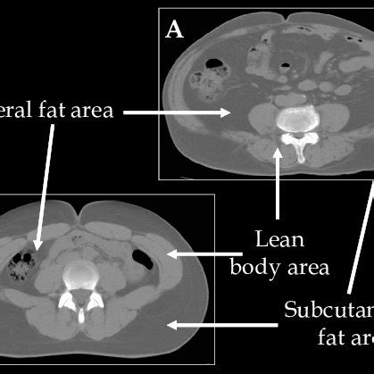 CT Scan 的图像结果
