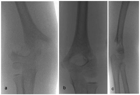 Pediatric Supracondylar Fracture of the Humerus with Sideward Displacement