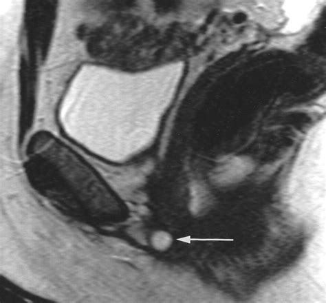 Bartholin Gland Cyst Mri