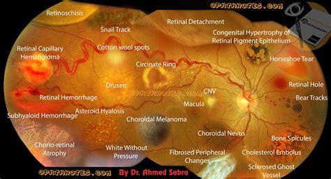 http://www.ophthnotes.com/retinal-diseases-signs-in-one-picture ...