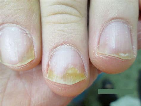 Nail psoriasis causes, symptoms, diagnosis, treatment & prognosis