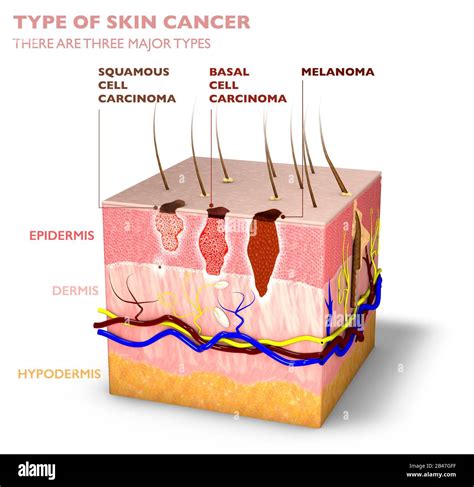 Basal Cell Carcinoma Malignant Melanoma