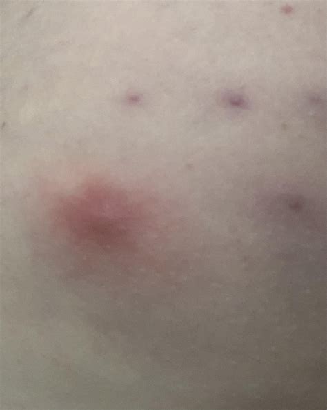 [Skin Concerns] Acne on butt (photo included so beware!!) or not? it’s been painful to sit down ...