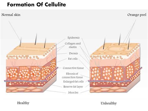 0814 Formation Of Cellulite Medical Images For Powerpoint | PowerPoint ...