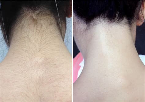 Neck Laser Hair Removal | 3D LifeStyle