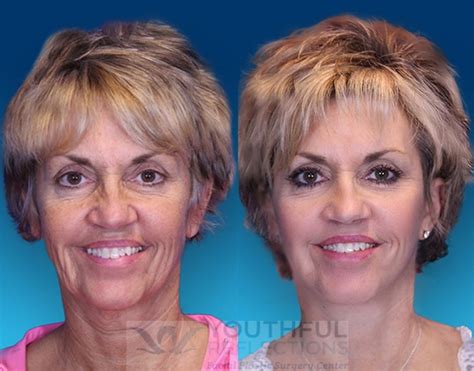 CO2 Laser Skin Resurfacing Before & After Photos Patient 1 | Nashville, TN | Youthful Reflections