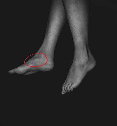 Accessory Navicular Syndrome | The Chelsea Clinic
