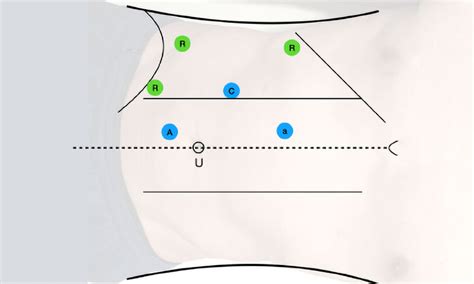 Image result for Nephrectomy Positioning