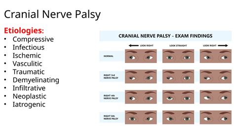How to deal with 3,4 and 6 cranial nerve palsy | PPTX
