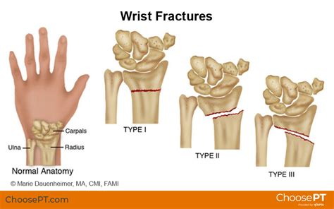 Guide | Physical Therapy Guide to Wrist Fracture | Choose PT