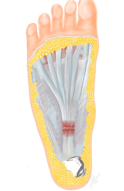 Plantar Fasciitis - Clinical Features - Management - TeachMeSurgery