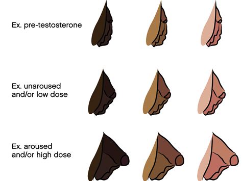 Ftm Transition Bottom Surgery