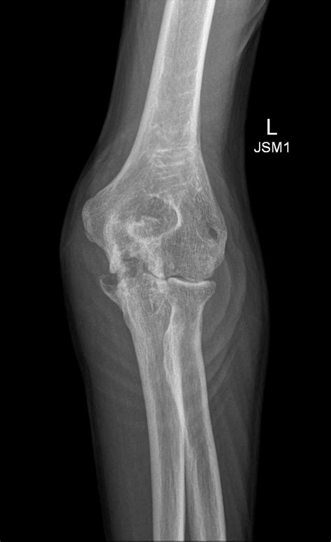Arthritis Elbow X Ray at Michael Gates blog