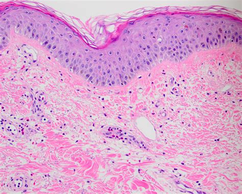 Pathology Outlines - Dermal hypersensitivity reaction