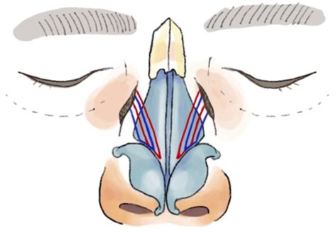 A Repair Technique for Internal Nasal Valve Collapse Using Lateral Nasal Suspension Sutures