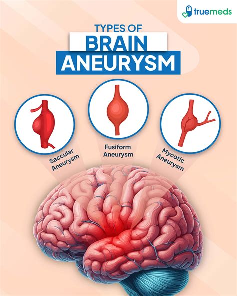 Brain Aneurysm: Causes, Symptoms & Treatment