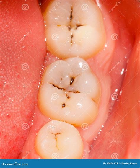 Cavity and teeth stock photo. Image of health, gingiva - 29699128