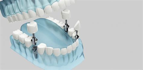 Why Full Mouth Implants Are Worth It – Must-Read!